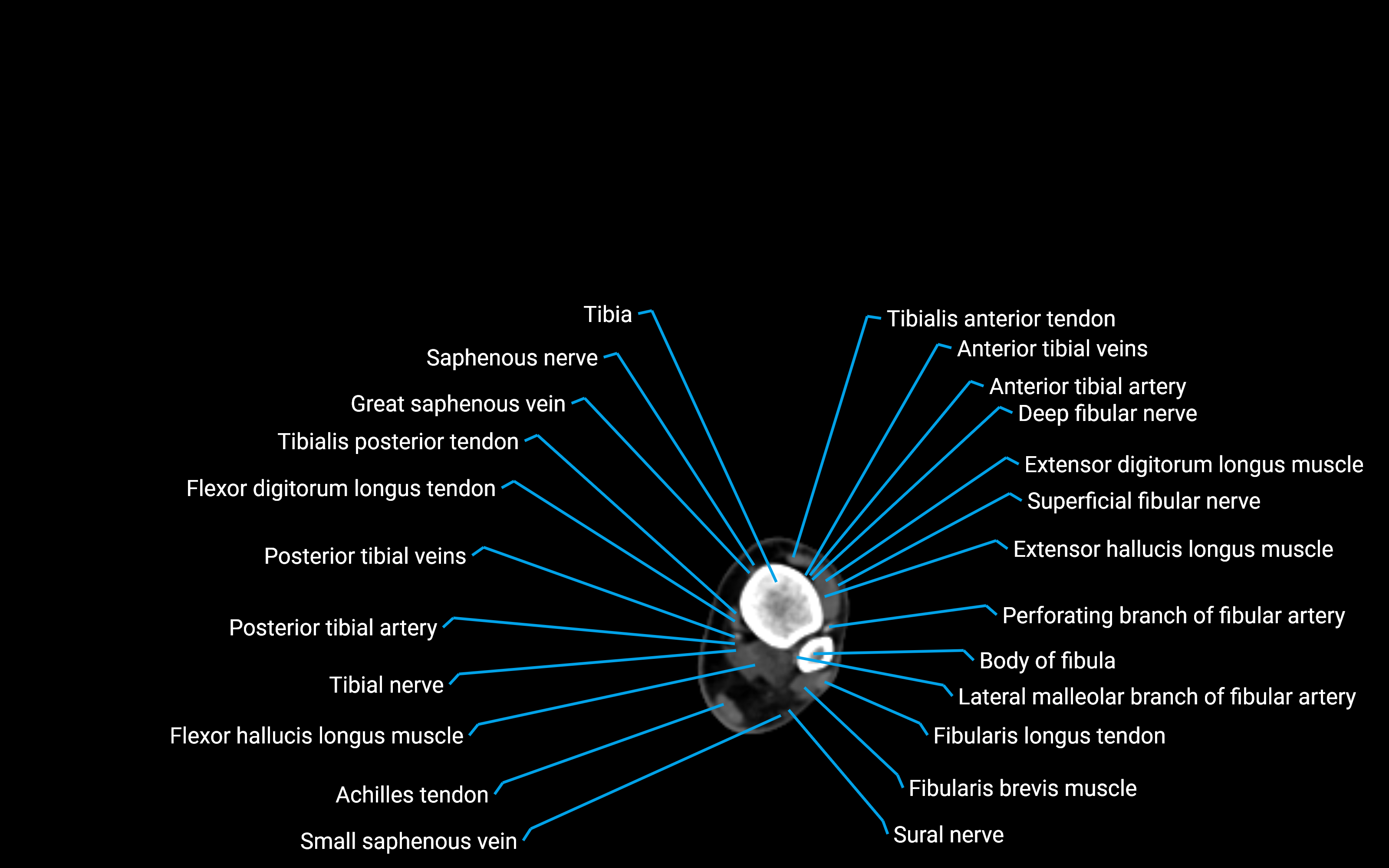 CT Lower leg axial cross sectional anatomy labelled image 161 (2).png